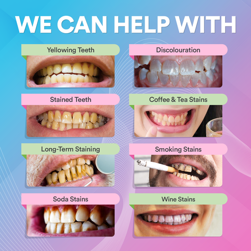 PureSmileTherapy™ Teeth Whitening Pen